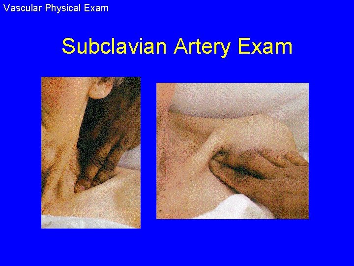 Vascular Physical Exam Subclavian Artery Exam 