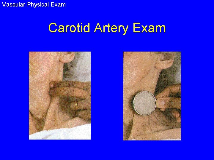 Vascular Physical Exam Carotid Artery Exam 