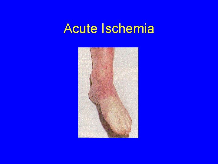 Acute Ischemia 