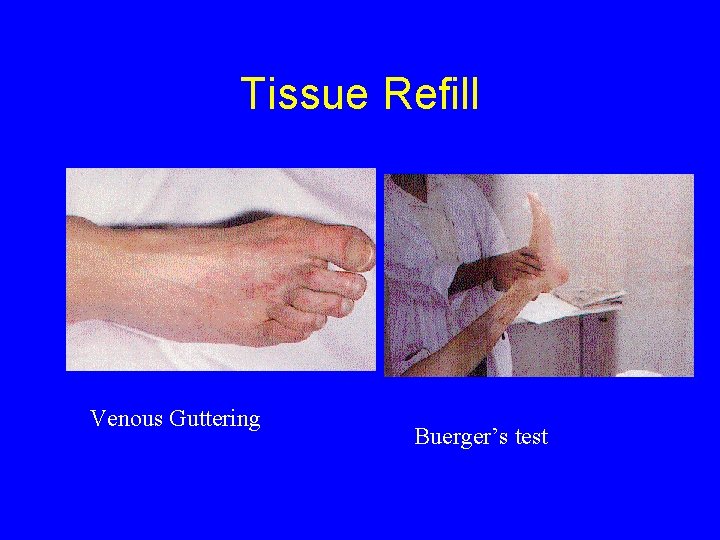 Tissue Refill Venous Guttering Buerger’s test 