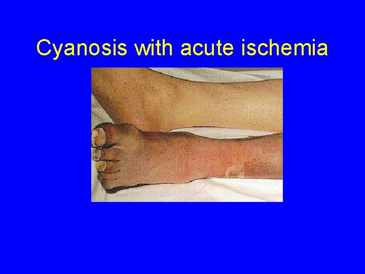 Cyanosis with acute ischemia 