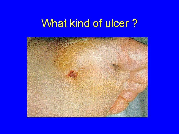 What kind of ulcer ? 