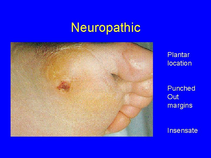 Neuropathic Plantar location Punched Out margins Insensate 