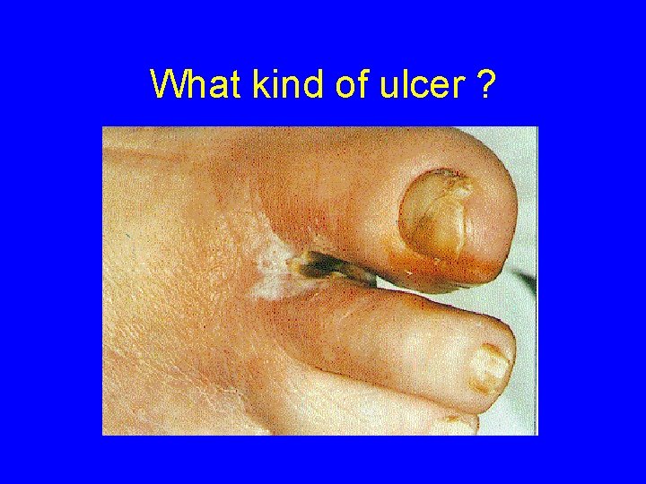 What kind of ulcer ? 