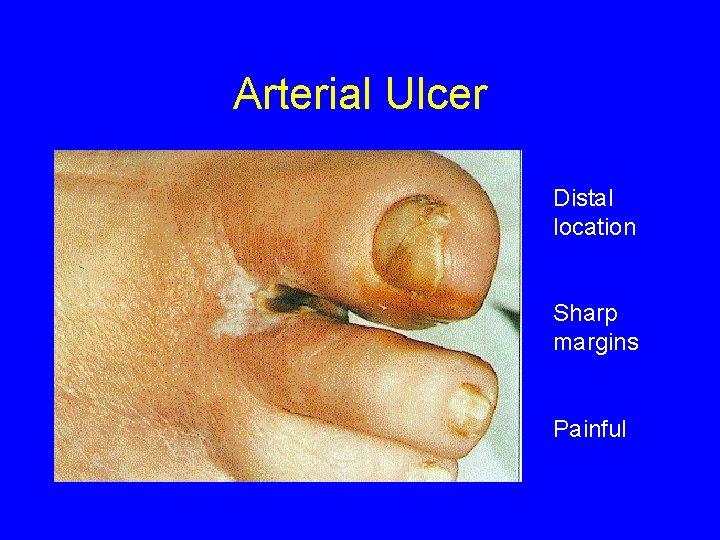 Arterial Ulcer Distal location Sharp margins Painful 