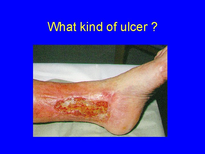 What kind of ulcer ? 