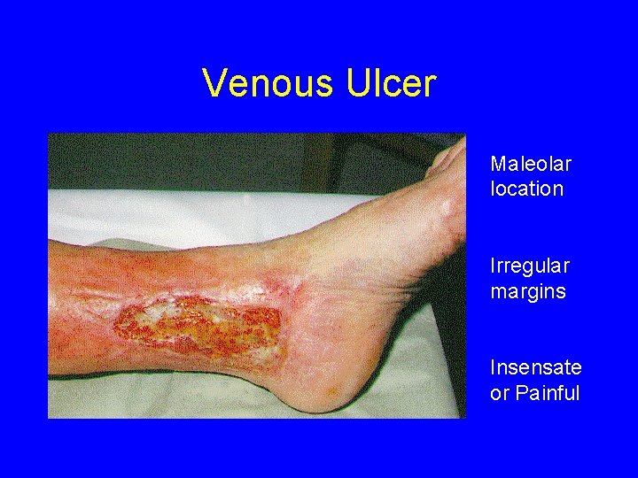 Venous Ulcer Maleolar location Irregular margins Insensate or Painful 
