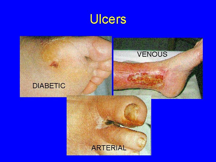 Ulcers VENOUS DIABETIC ARTERIAL 