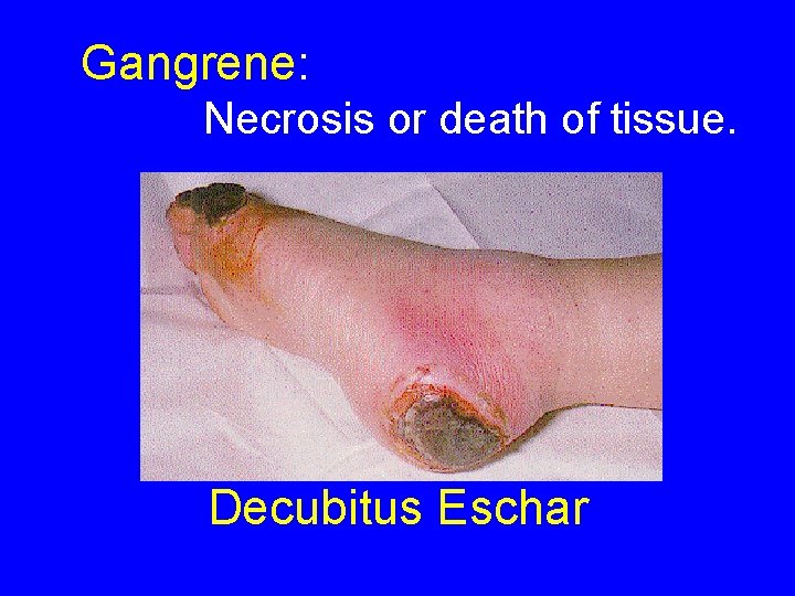 Gangrene: Necrosis or death of tissue. Decubitus Eschar 