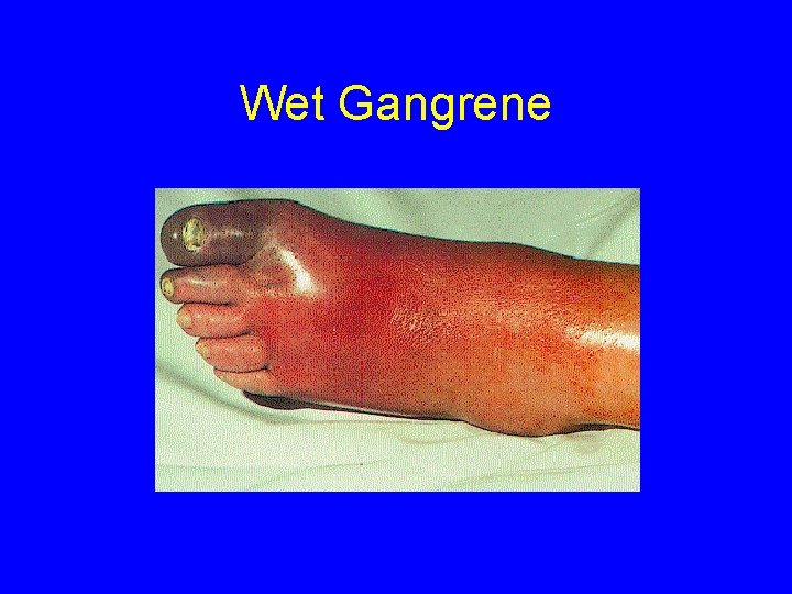 Wet Gangrene 