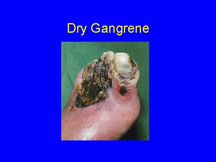 Dry Gangrene 