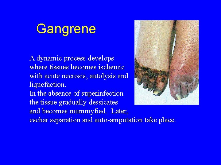 Gangrene A dynamic process develops where tissues becomes ischemic with acute necrosis, autolysis and