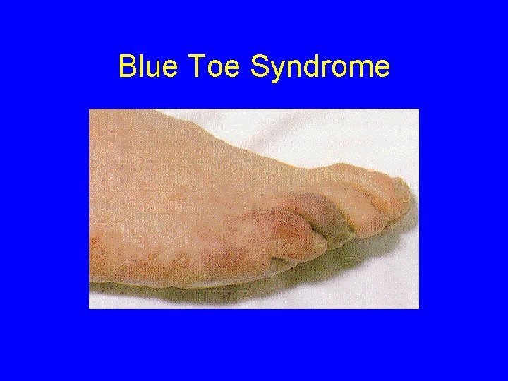 Blue Toe Syndrome 