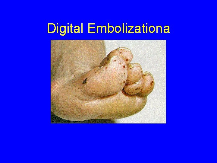 Digital Embolizationa 