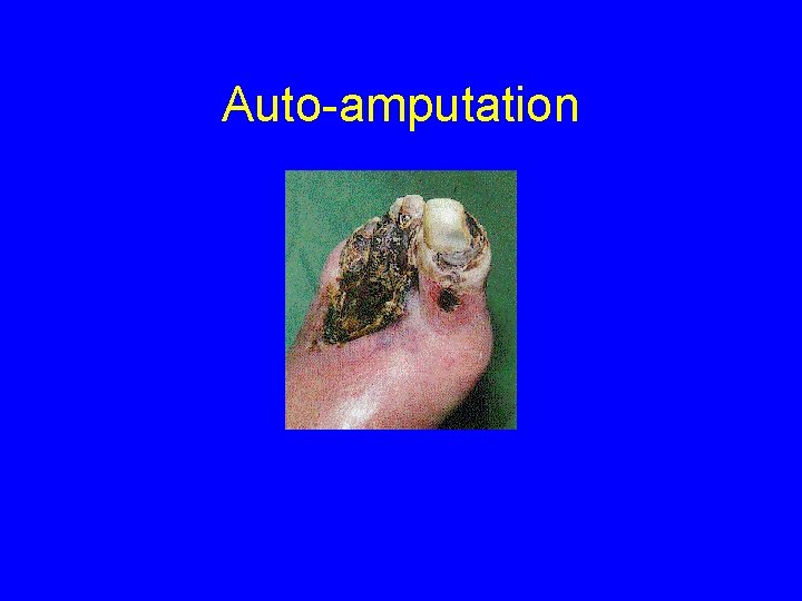 Auto-amputation 