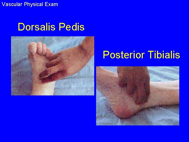 Vascular Physical Exam Dorsalis Pedis Posterior Tibialis 