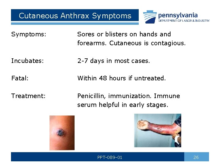 Cutaneous Anthrax Symptoms: Sores or blisters on hands and forearms. Cutaneous is contagious. Incubates: