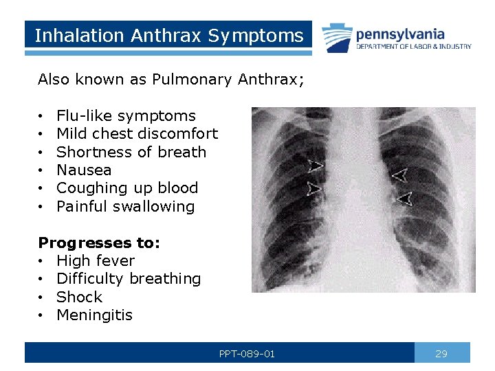 Inhalation Anthrax Symptoms Also known as Pulmonary Anthrax; • • • Flu-like symptoms Mild