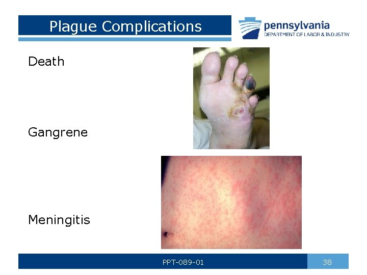 Plague Complications Death Gangrene Meningitis PPT-089 -01 38 