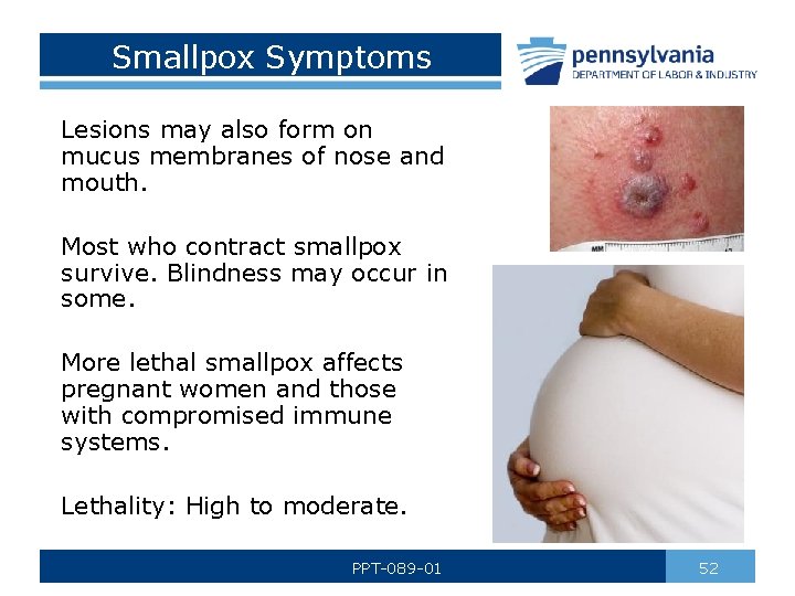 Smallpox Symptoms Lesions may also form on mucus membranes of nose and mouth. Most