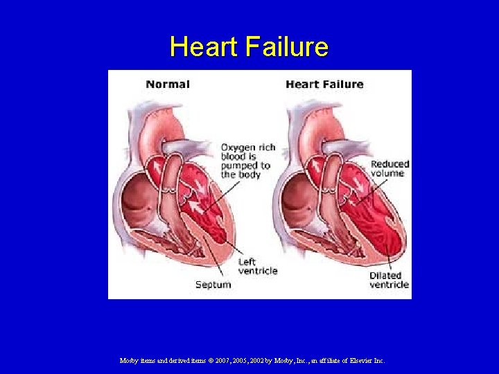 Heart Failure Mosby items and derived items © 2007, 2005, 2002 by Mosby, Inc.