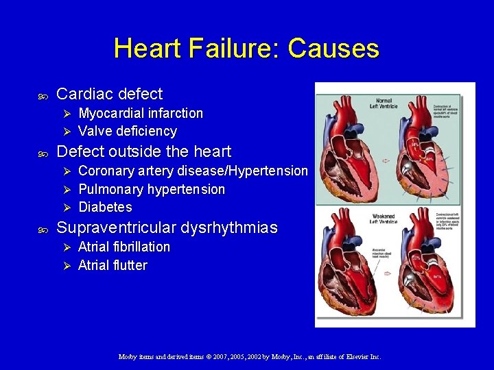 Heart Failure: Causes Cardiac defect Myocardial infarction Ø Valve deficiency Ø Defect outside the