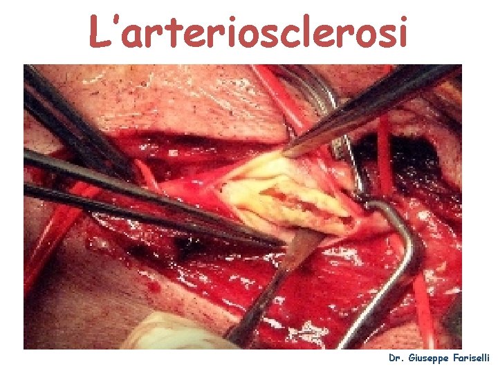 L’arteriosclerosi Dr. Giuseppe Fariselli 