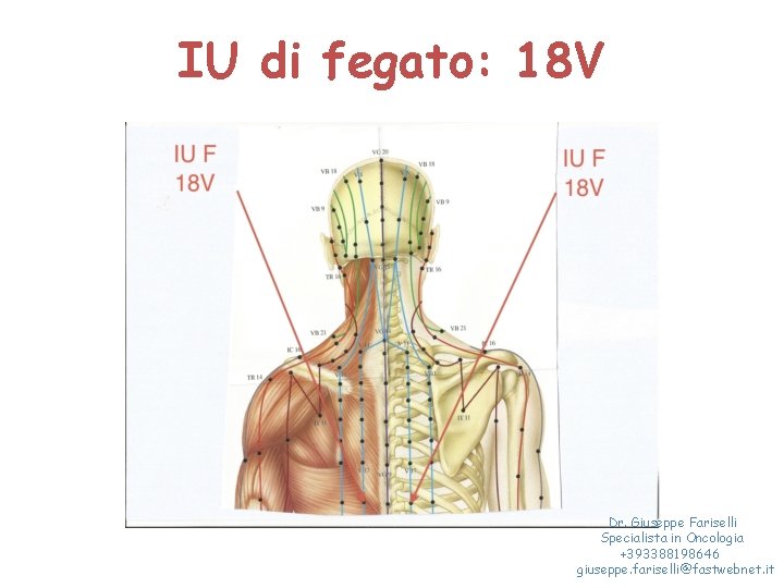 IU di fegato: 18 V Dr. Giuseppe Fariselli Specialista in Oncologia +393388198646 giuseppe. fariselli@fastwebnet.