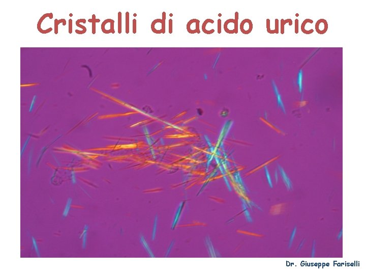 Cristalli di acido urico Dr. Giuseppe Fariselli 