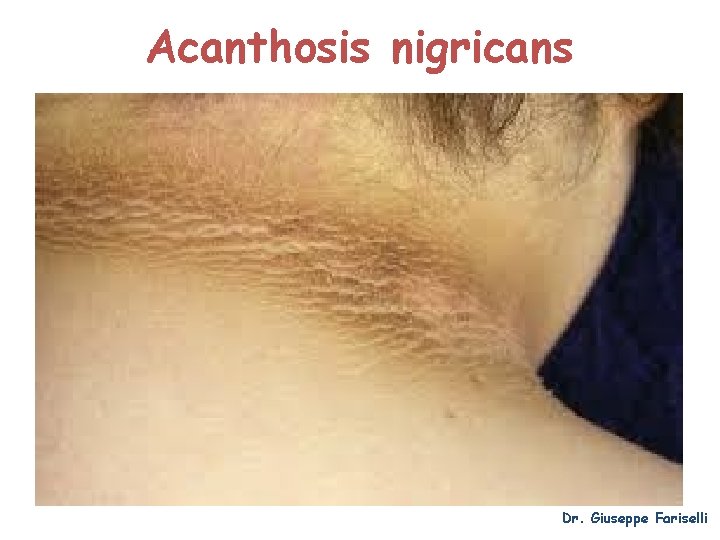 Acanthosis nigricans Dr. Giuseppe Fariselli 