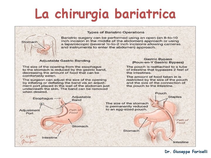 La chirurgia bariatrica Dr. Giuseppe Fariselli 