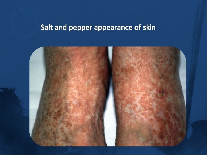 Salt and pepper appearance of skin 