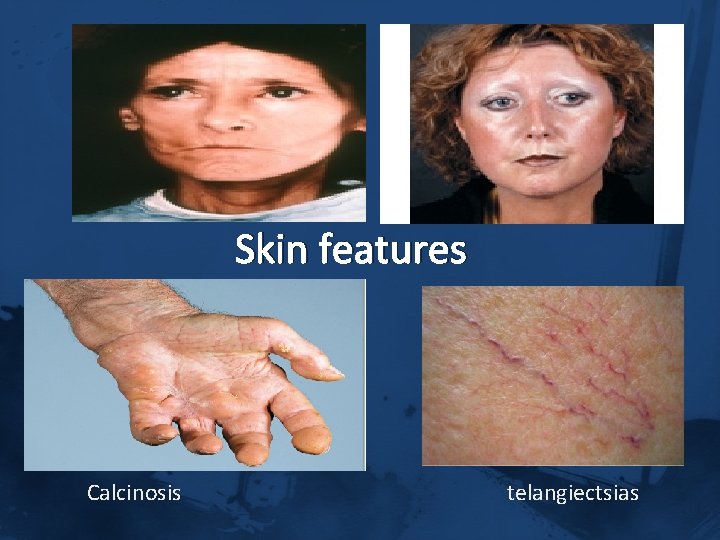 Skin features Calcinosis telangiectsias 