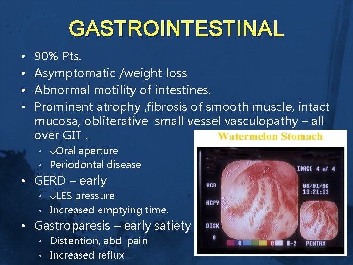 GASTROINTESTINAL • • 90% Pts. Asymptomatic /weight loss Abnormal motility of intestines. Prominent atrophy