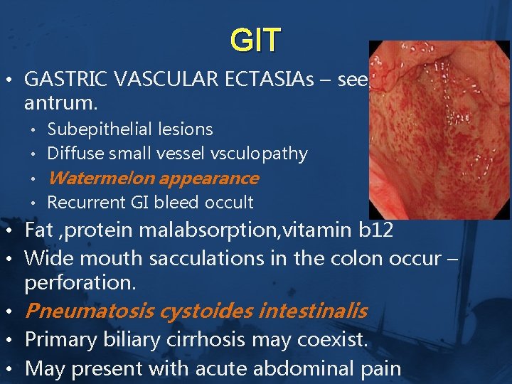 GIT • GASTRIC VASCULAR ECTASIAs – seen in the antrum. • Subepithelial lesions •