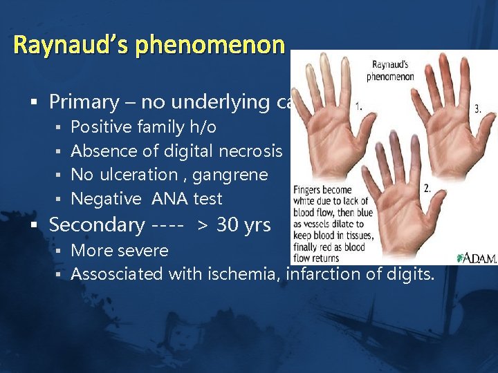 Raynaud’s phenomenon § Primary – no underlying causes § Positive family h/o § Absence