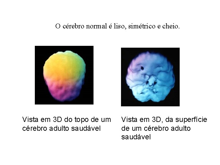 O cérebro normal é liso, simétrico e cheio. Vista em 3 D do topo