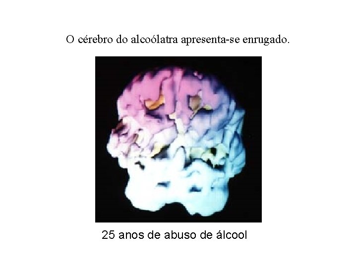 O cérebro do alcoólatra apresenta-se enrugado. 25 anos de abuso de álcool 
