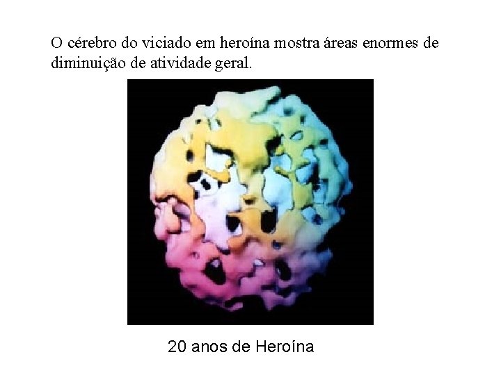 O cérebro do viciado em heroína mostra áreas enormes de diminuição de atividade geral.