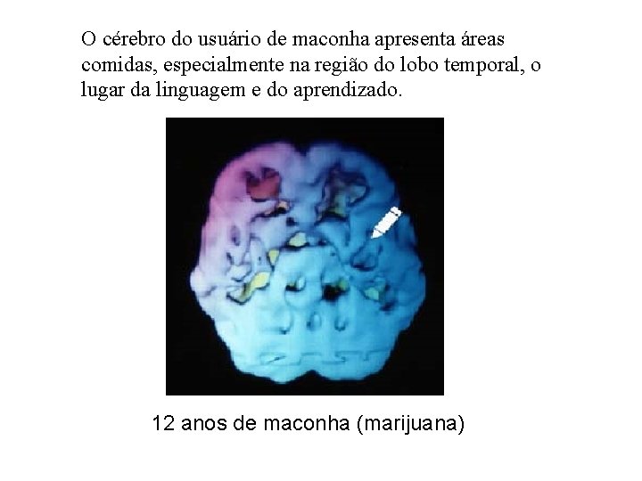 O cérebro do usuário de maconha apresenta áreas comidas, especialmente na região do lobo