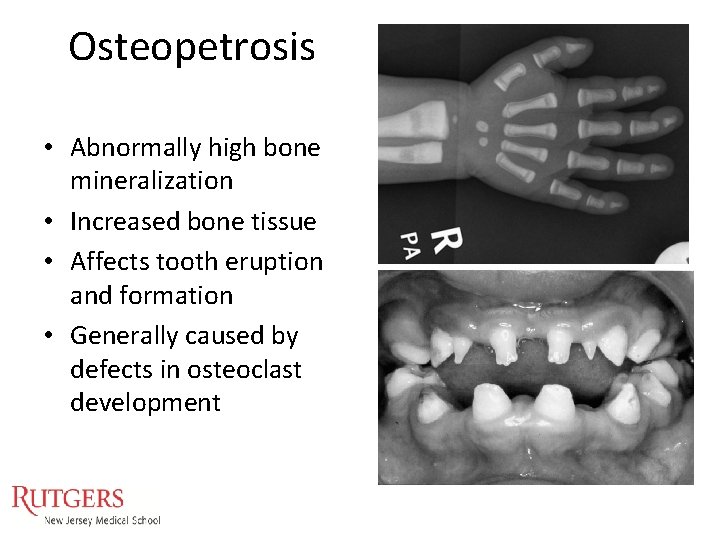 Osteopetrosis • Abnormally high bone mineralization • Increased bone tissue • Affects tooth eruption Osteopetrosis • Abnormally high bone mineralization • Increased bone tissue • Affects tooth eruption