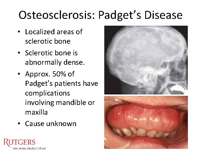 Osteosclerosis: Padget’s Disease • Localized areas of sclerotic bone • Sclerotic bone is abnormally Osteosclerosis: Padget’s Disease • Localized areas of sclerotic bone • Sclerotic bone is abnormally