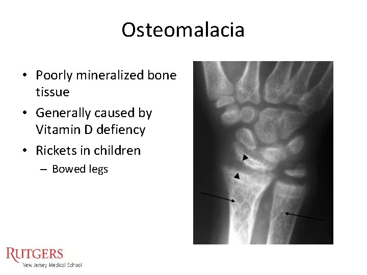 Osteomalacia • Poorly mineralized bone tissue • Generally caused by Vitamin D defiency • Osteomalacia • Poorly mineralized bone tissue • Generally caused by Vitamin D defiency •