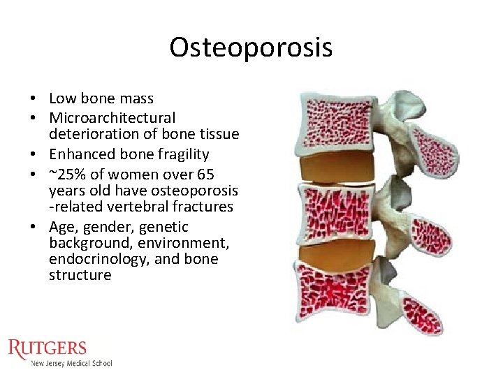 Osteoporosis • Low bone mass • Microarchitectural deterioration of bone tissue • Enhanced bone Osteoporosis • Low bone mass • Microarchitectural deterioration of bone tissue • Enhanced bone