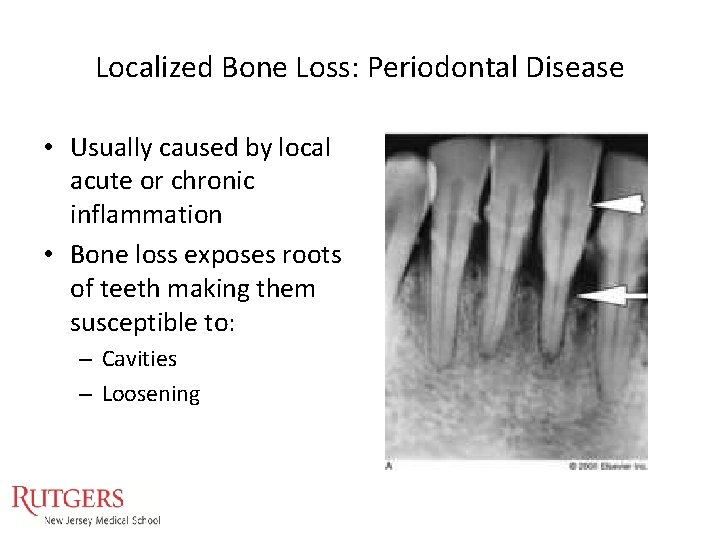 Localized Bone Loss: Periodontal Disease • Usually caused by local acute or chronic inflammation Localized Bone Loss: Periodontal Disease • Usually caused by local acute or chronic inflammation