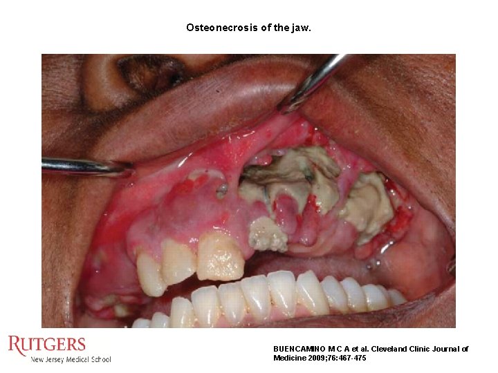 Osteonecrosis of the jaw. BUENCAMINO M C A et al. Cleveland Clinic Journal of Osteonecrosis of the jaw. BUENCAMINO M C A et al. Cleveland Clinic Journal of