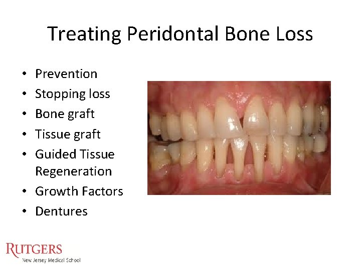 Treating Peridontal Bone Loss Prevention Stopping loss Bone graft Tissue graft Guided Tissue Regeneration Treating Peridontal Bone Loss Prevention Stopping loss Bone graft Tissue graft Guided Tissue Regeneration