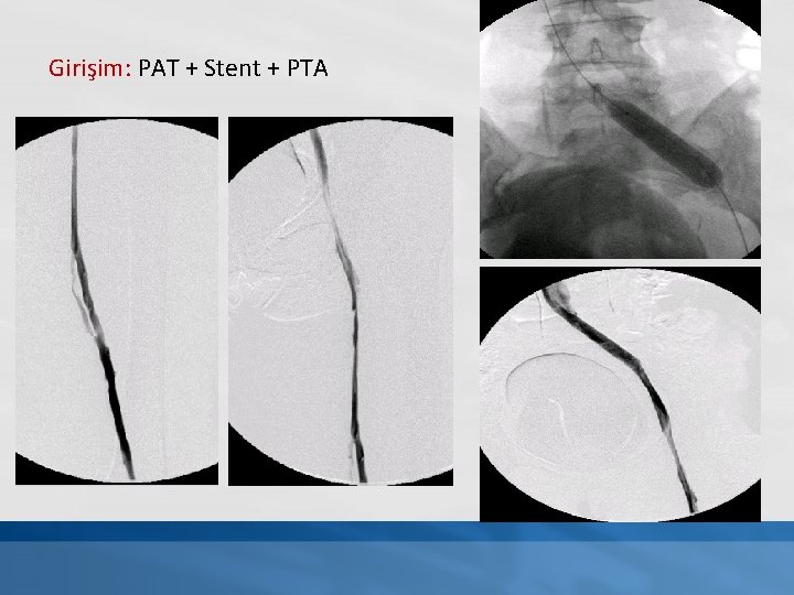 Girişim: PAT + Stent + PTA 