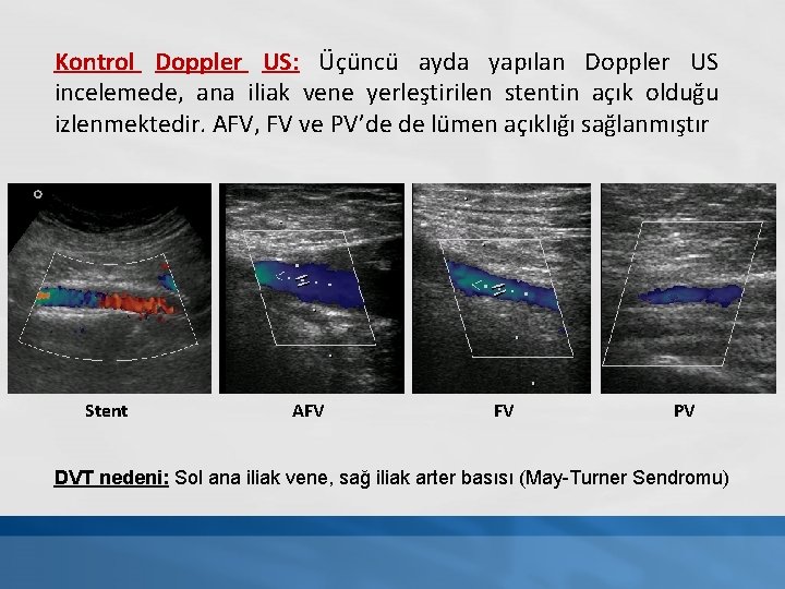 Kontrol Doppler US: Üçüncü ayda yapılan Doppler US incelemede, ana iliak vene yerleştirilen stentin