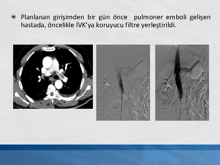 Planlanan girişimden bir gün önce pulmoner emboli gelişen hastada, öncelikle İVK’ya koruyucu filtre yerleştirildi.